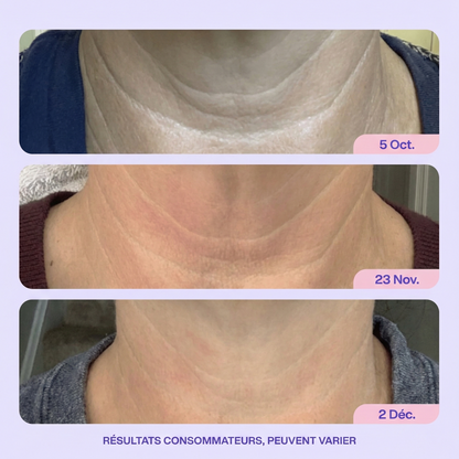 Un cou plus ferme et lisse en 4 semaines - ou remboursé