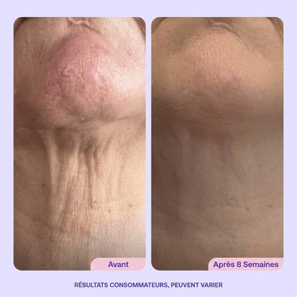 Un cou plus ferme et lisse en 4 semaines - ou remboursé